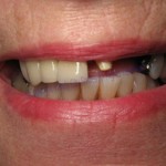 Windy City Smiles - Chicago Dentist - Implants1 1