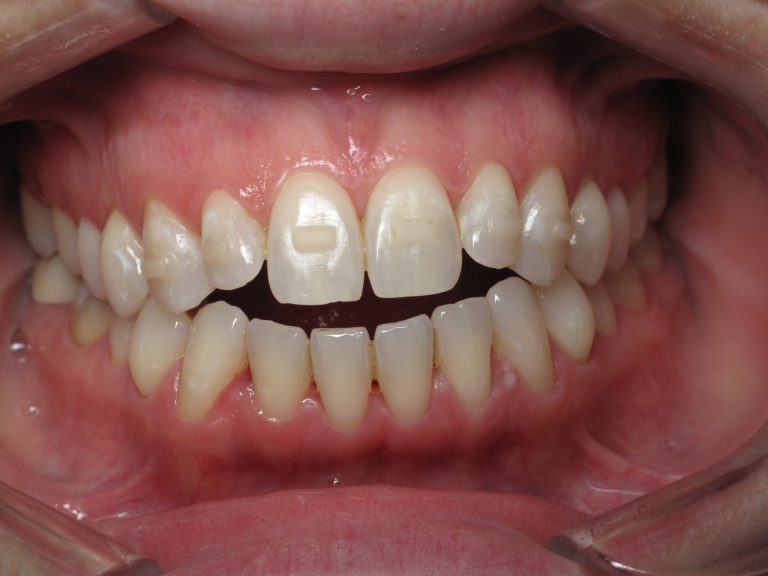 Chicago Clear Aligners