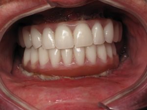 teeth whitening