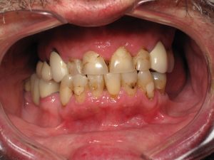 Teeth whitening