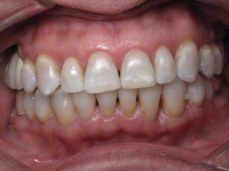 teeth whitening