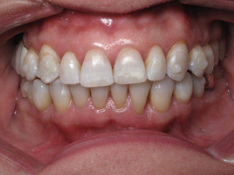 teeth whitening